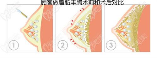 朱云醫(yī)生隆胸負(fù)面新聞