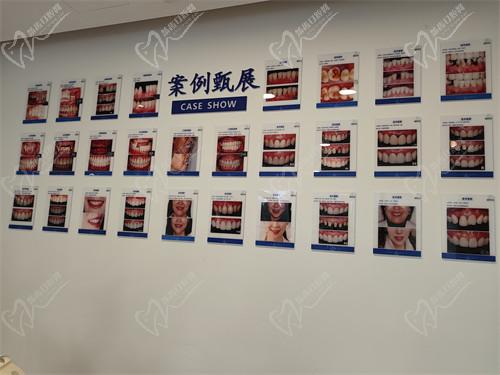 四、固德口腔種植牙的價(jià)格明細(xì)