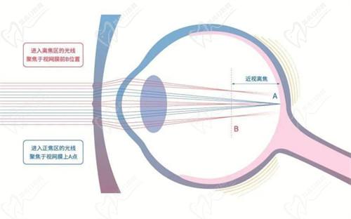 三、 全優(yōu)學(xué)鏡片成效評估：臨床研究與用戶反饋綜合分析