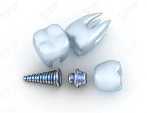 固德口腔種植牙價(jià)目表-2025全新版：公布固德口腔種一顆牙多少錢(qián)？